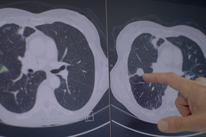 Two x-ray images show a tumour in the lung has almost disappeared.