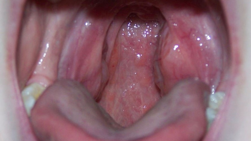 A generic image of tonsils.