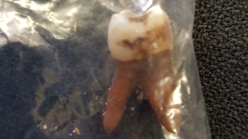 Decayed tooth in bag
