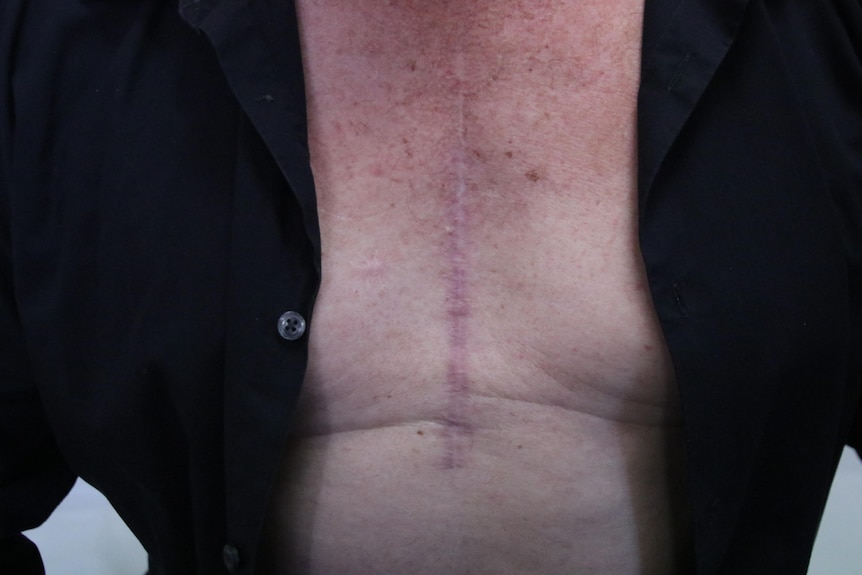 A man's chest with his shirt open to reveal a scar as a result of heart surgery.