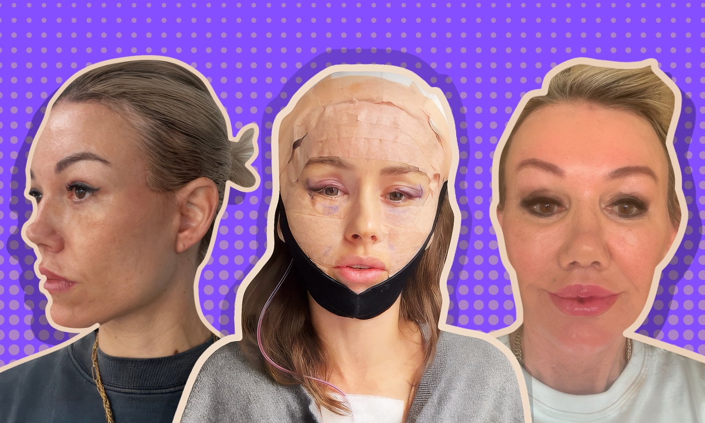 Plastic surgeons warn of complications as Australians seek face lifts overseas