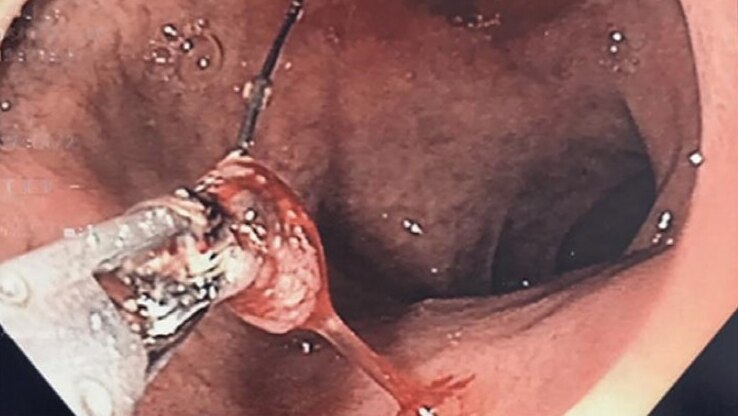 A BBQ bristle is removed from a man's pancreas with pliers.
