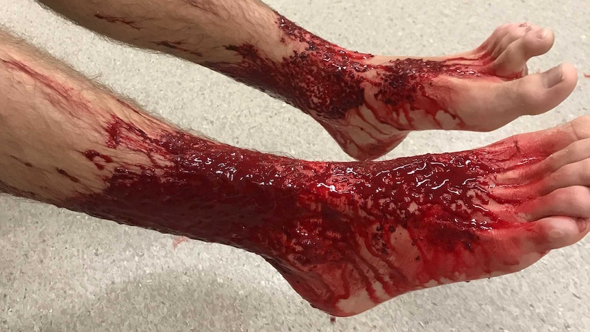 Blood on Sam Kanizay's legs and feet after he was apparently bitten by small marine creatures.