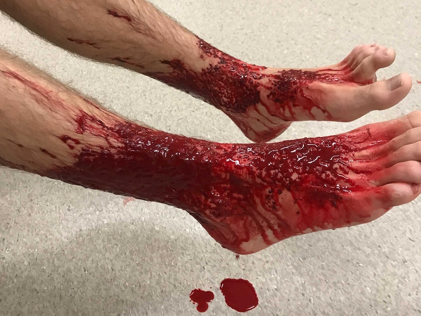 Blood on Sam Kanizay's legs and feet after he was apparently bitten by small marine creatures.