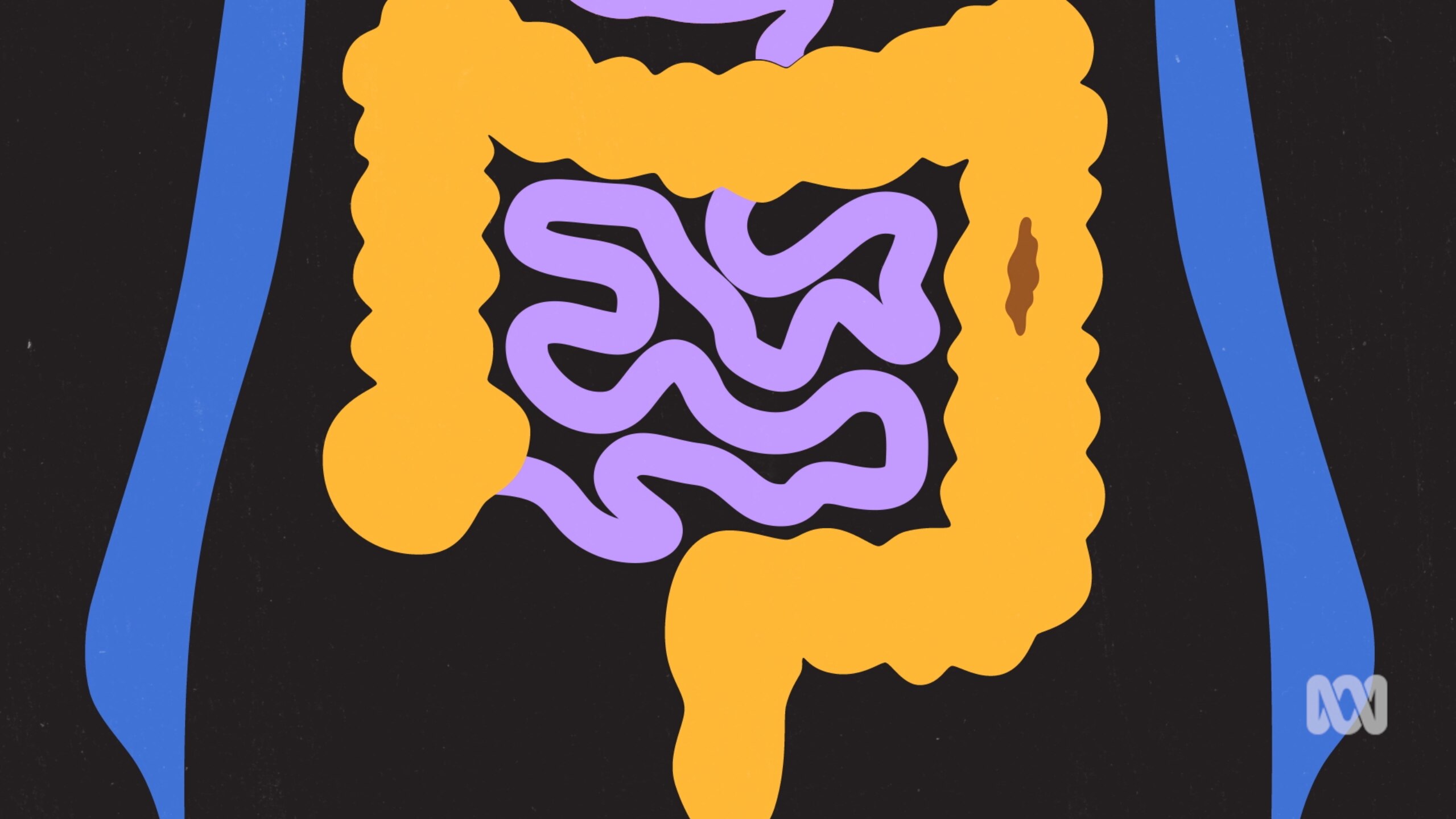 Colourful illustration of the small intestine and large intestine, with a brown mass moving down the descending colon.