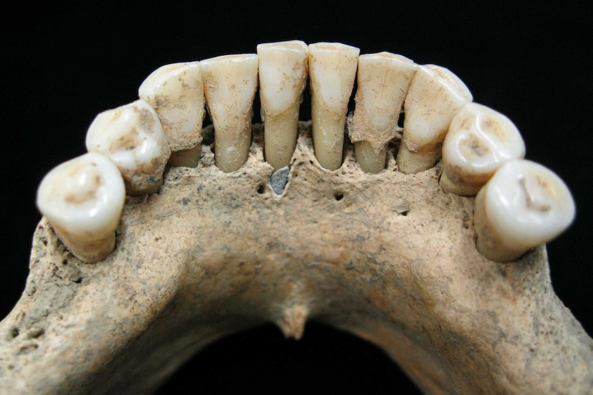 A picture of medieval teeth with small blue-ish lapis lazuli pigment.