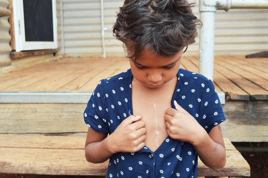 A young Indigenous girl pulls her shirt apart to reveal a big vertical scar on her chest.