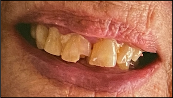 An older person's mouth with a chipped front tooth