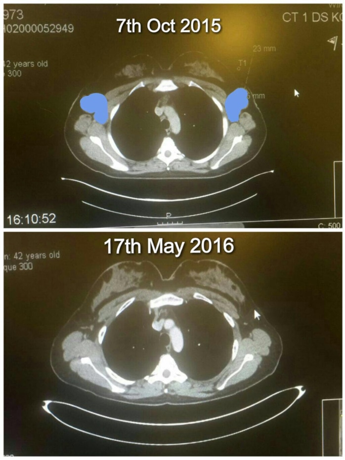 Before and after cancer scans for Deborah Sims