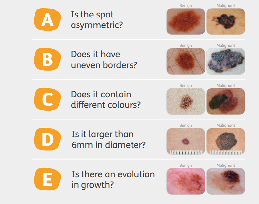 Images of different melanomas labelled A to E. Some questions are: Is the spot asymmetric? Does it have uneven borders? 