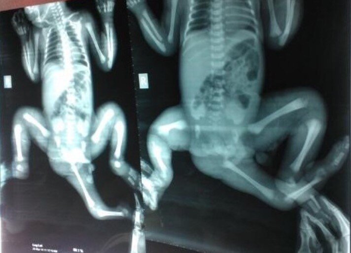 Bangladeshi girl born with three legs can walk, run thanks to team at ...