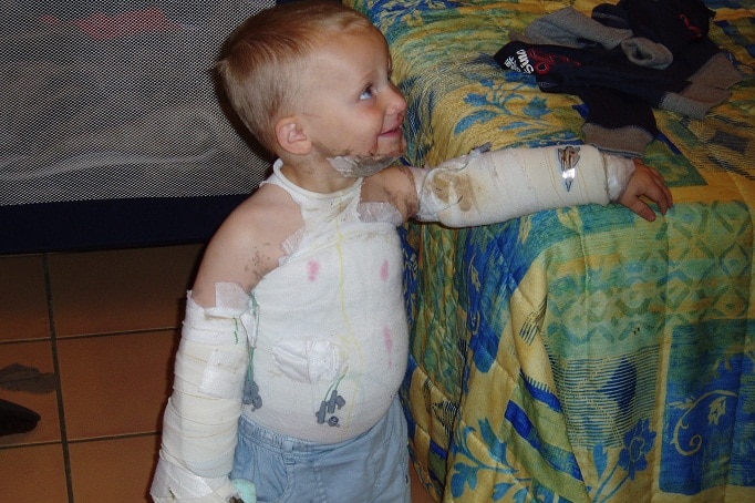 Keats Sullivan was treated by the RFDS for severe burns he suffered as a child.