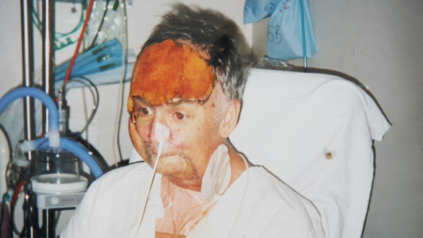 A man with facial injuries sits in a hospital bed