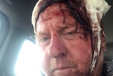 Close up of Tom Sommer, who has a bloodied bandage wrapped around his head.