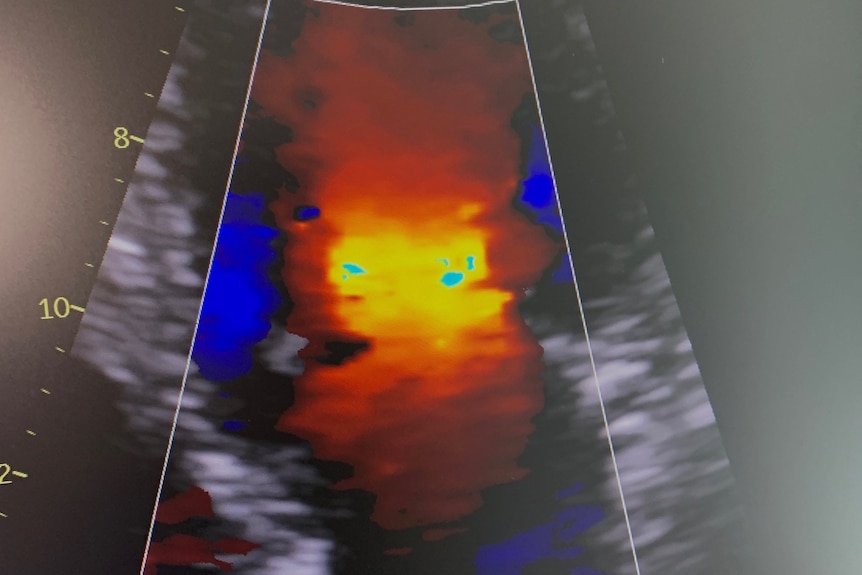 A colourful echocardiogram image.