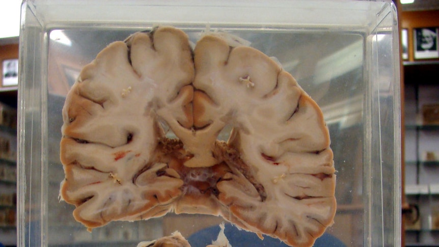 A brain affected by multiple sclerosis