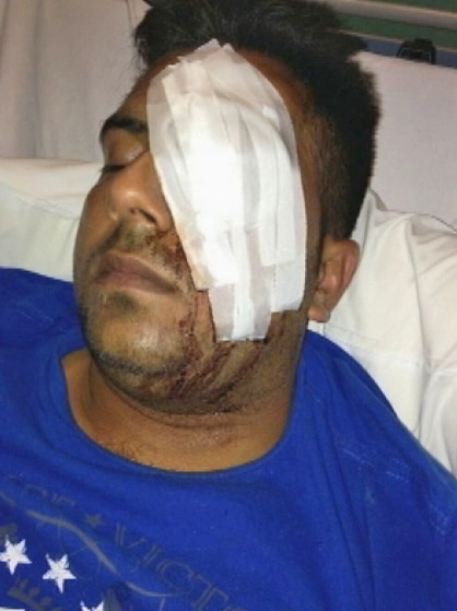 Manbir Singh was bashed and cannot see from his left eye