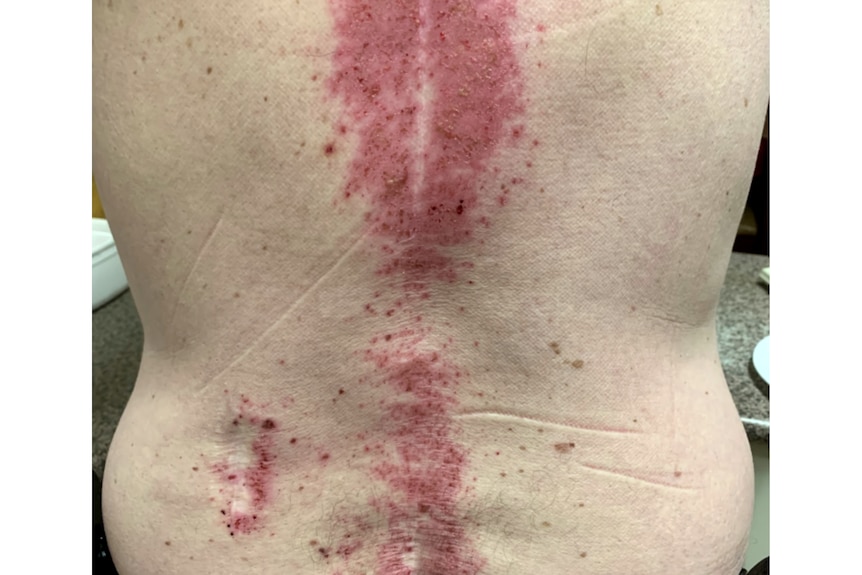 A person's naked back with red marks on the skin all down the spine