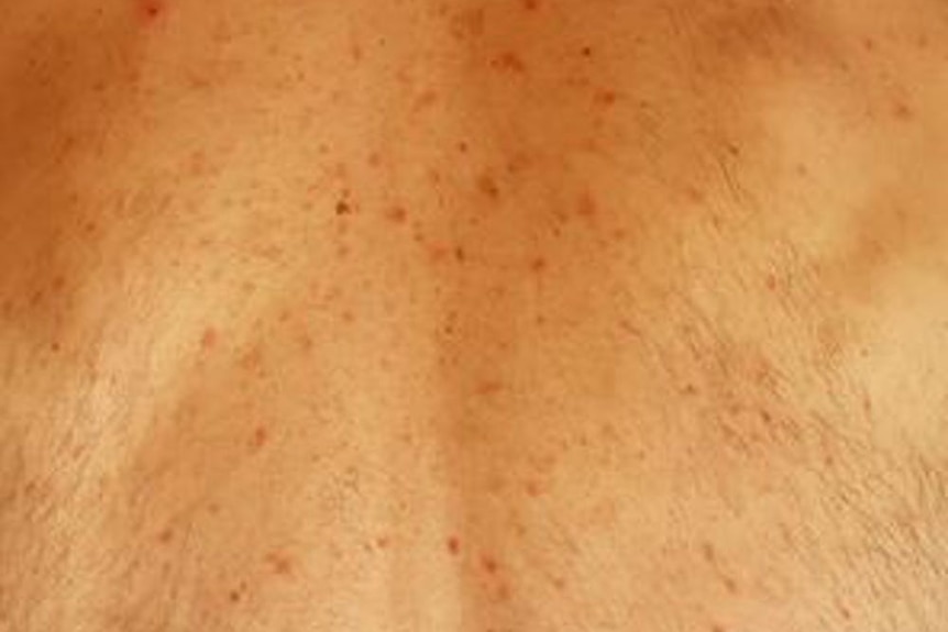 These water blisters, or vesicular eruptions, are more common in middle-aged people with COVID-19.