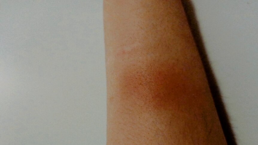 A photo of a woman's arm with dark bruises