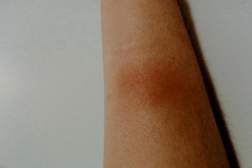 A photo of a woman's arm with dark bruises