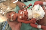 Premature baby with monitors and tubes attached being held inside a humidicrib.