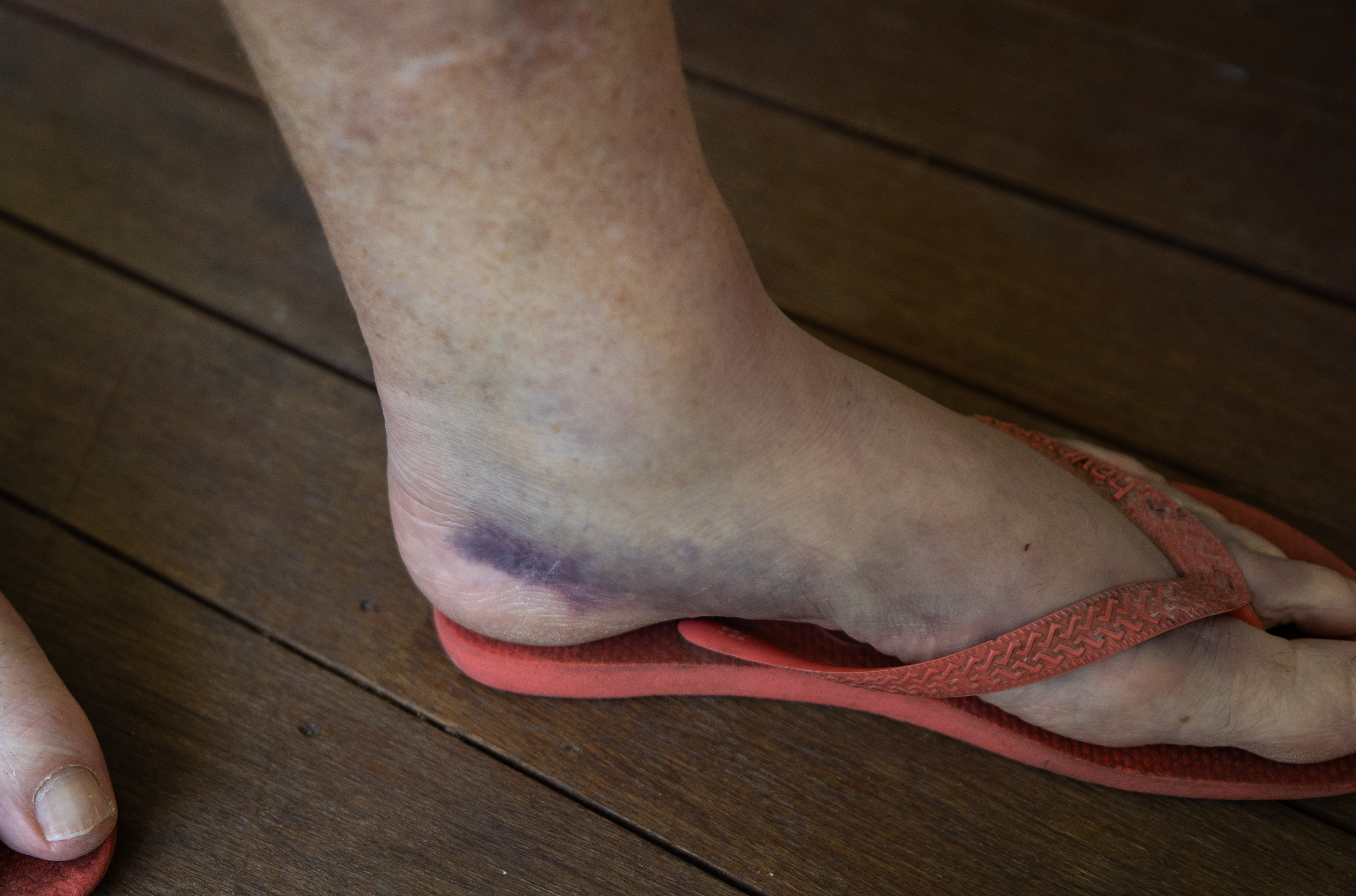 Foto de hematomas en el pie de una persona que llevaba tanga.