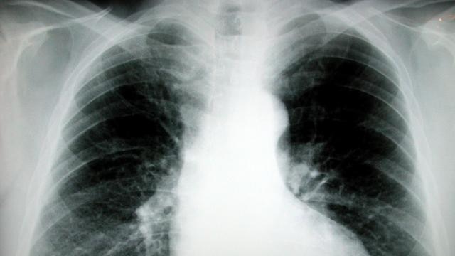 A chest x-ray.