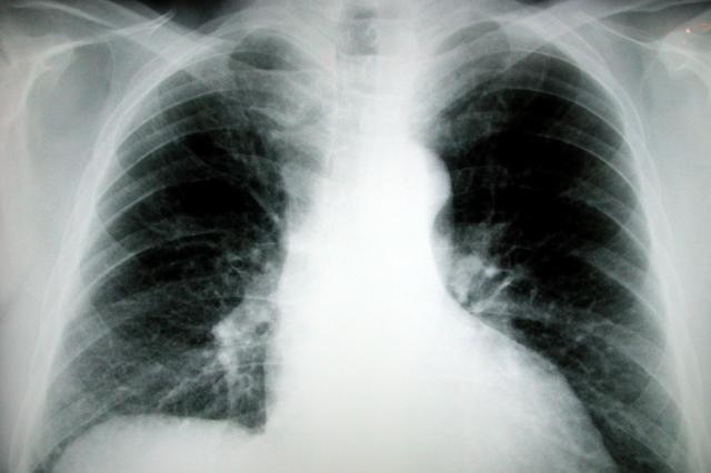 Chest X-ray