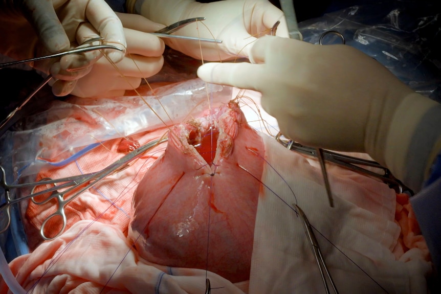 Hands of surgeons stitching up a uterus during spina bifida surgery.