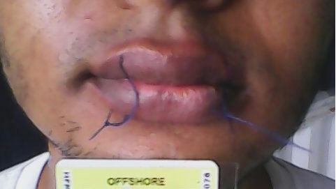 Asylum seeker sews lips shut in protest