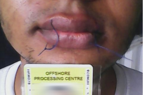 Asylum seeker sews lips shut in protest