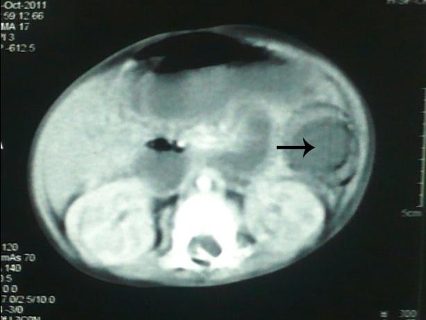 An CT scan of a belly, with arrow pointing at dark circle.