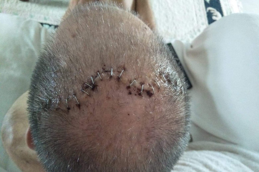 A man's skull with medical staples after being assaulted in prison.