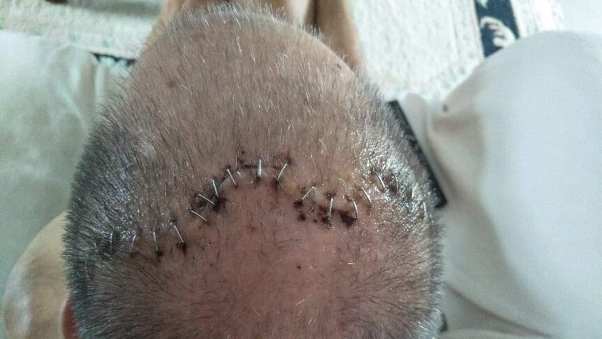 A man's skull with medical staples after being assaulted in prison.