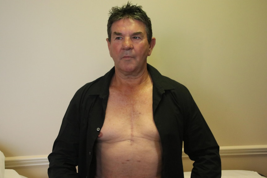 A man sits with his shirt open to reveal a scar that came from heart surgery.