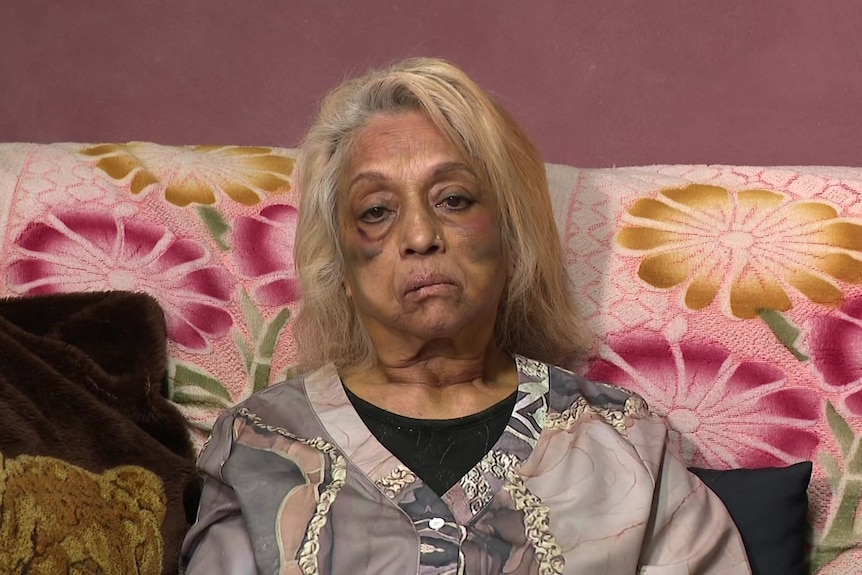 Ninette Simons with severe facial bruising some days after the attack.