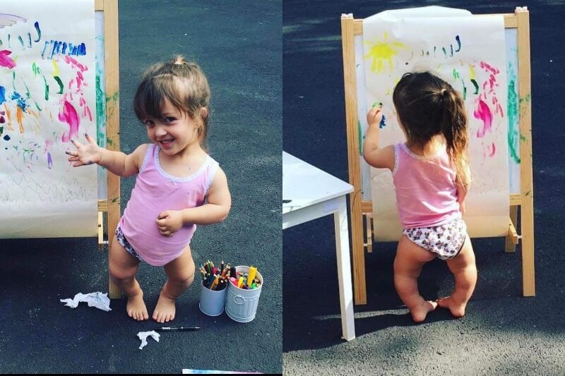 a composite image of a little girl painting on an easel, she has dwarfism and her legs are extremely bowed outwards