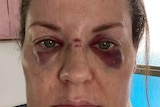 A woman with bruised eyes and cuts on her nose