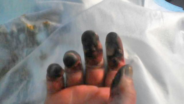 Blackened fingers before amputations were performed.