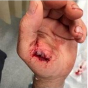 A deep wound on the hand of a man attacked by a dog in Melbourne.