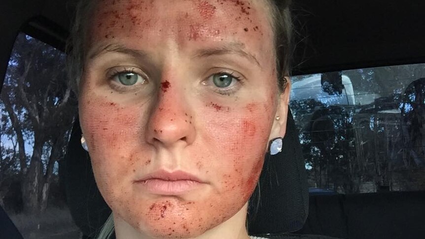 Nic Dolbel with burns and redness on her skin.