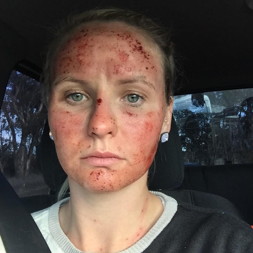 Nic Dolbel with burns and redness on her skin.