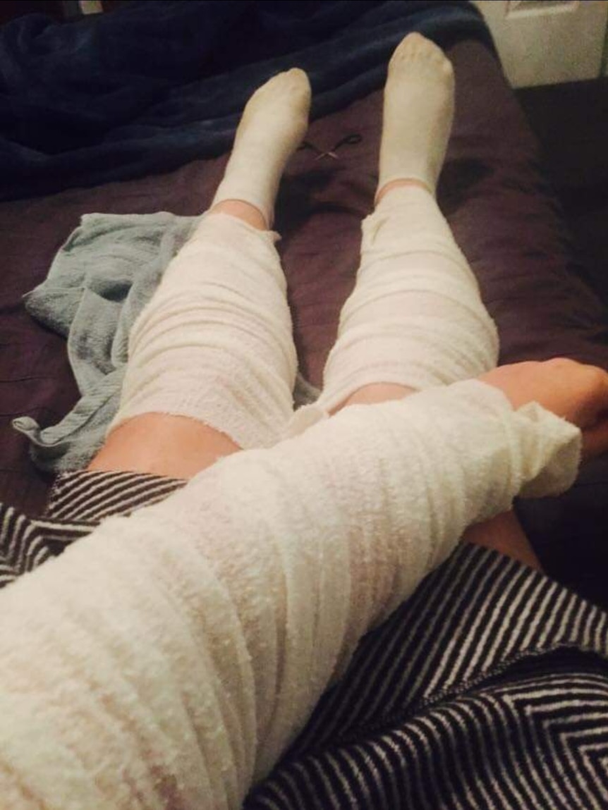 A woman's legs and arm wrapped in bandages 