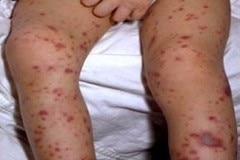 A pair of legs covered in a red and purple rash