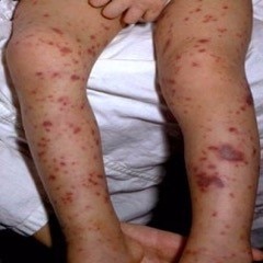 Meningococcal rash