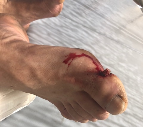 A stingray barb impaled Chris Black's foot.