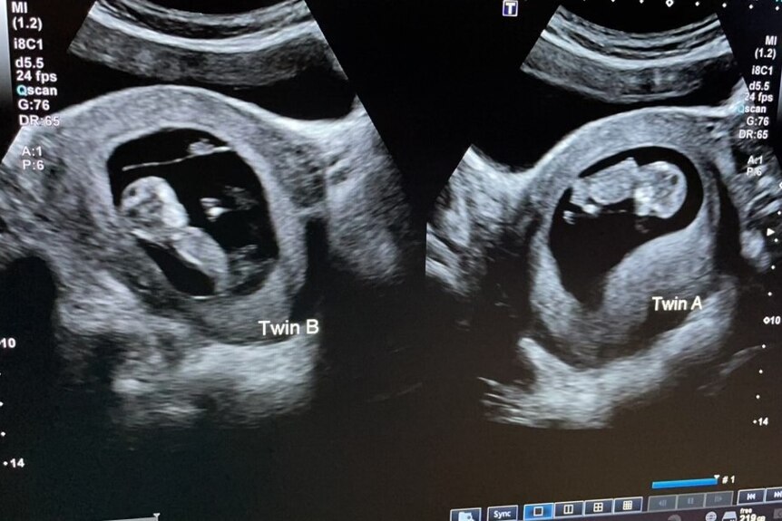 A black and white ultrasound screen shows two twin babies