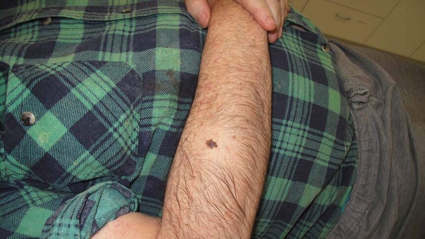Jenis tahi lalat yang diperkirakan berisiko tinggi terkena melanoma.