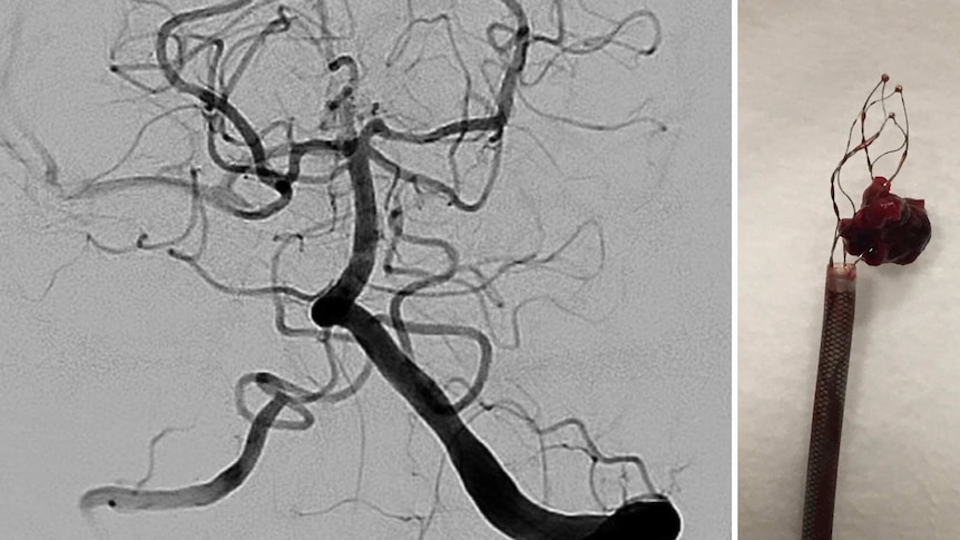 Medical images of Melbourne man Wally Ballard's blood clot that left him with locked-in syndrome.